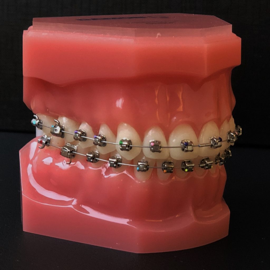 Orthodontie Beugelen